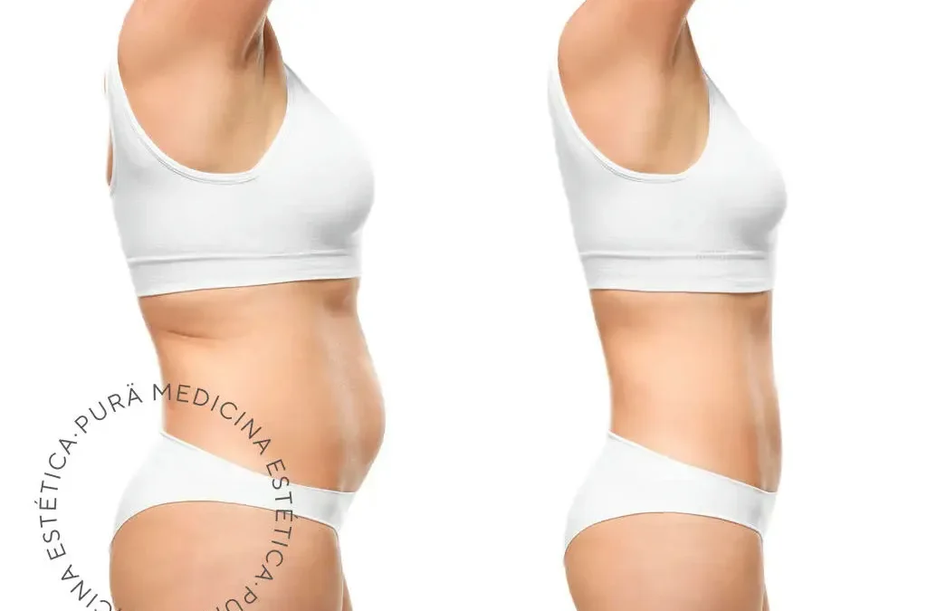 Descubre la Innovación Estética: Radiofrecuencia Morpheus 8 y Coolsculpting