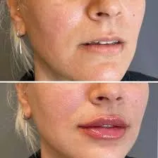 Ácido hialurónico en labios y tratamientos faciales: estética natural y precisa